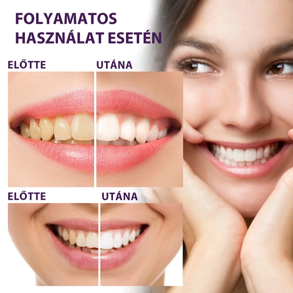 EELHOE Fogfehérítő Gél - 50 ml