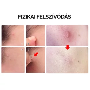 LANBENA Átlátszó Pattanás Eltávolító Tapasz