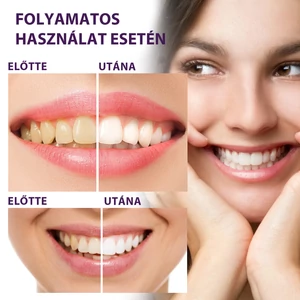 EELHOE Fogfehérítő Gél - 50 ml